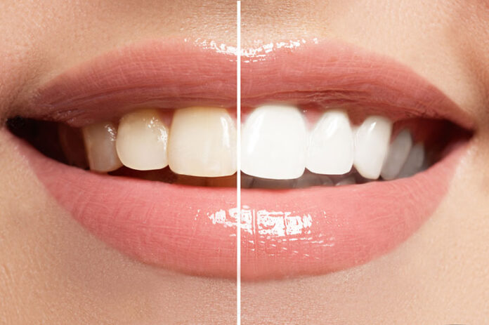 Teeth Whitening